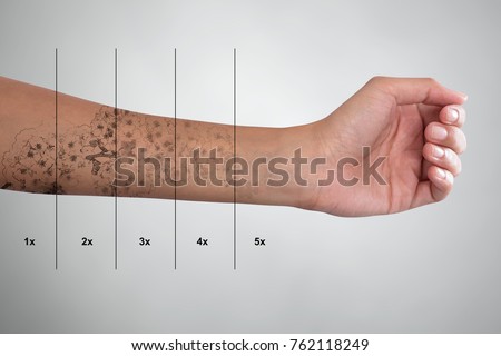 Laser Tattoo Removal On Woman's Hand Against Grey Background Royalty-Free Stock Photo #762118249
