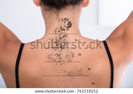 Laser Tattoo Removal On Woman's Back Against White Background Royalty-Free Stock Photo #762118252