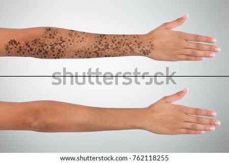 Close-up Of Woman's Hand Before And After Laser Tattoo Removal Treatment Royalty-Free Stock Photo #762118255