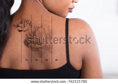 Close-up Of A Laser Tattoo Removal On Woman's Back Royalty-Free Stock Photo #762121780