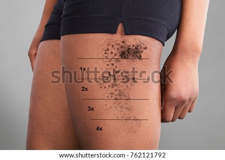 Midsection View Of A Laser Tattoo Removal On Woman's Thigh Royalty-Free Stock Photo #762121792