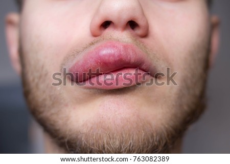 angioedema. Allergic reaction to the lip. Hives Royalty-Free Stock Photo #763082389