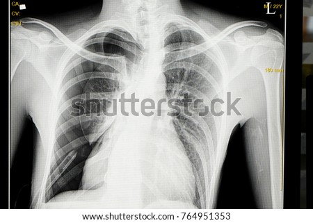 Chest X Ray film of a male patient with spontaneous pneumothorax with almost totally collapsed right lung.  A chest drain is also seen