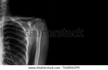 x-ray shoulder in gray tone with space right side(banner)