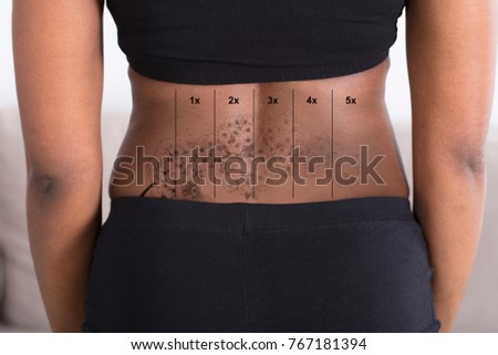 Midsection View Of A Laser Tattoo Removal On Woman's Hip Royalty-Free Stock Photo #767181394