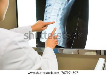 closeup of professional doctor check up x-ray image have problem spine of patient. medical and healthcare concept.