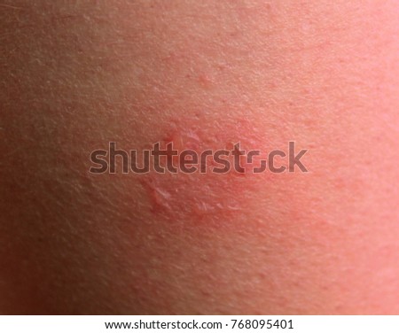 First degree burn close-up Royalty-Free Stock Photo #768095401