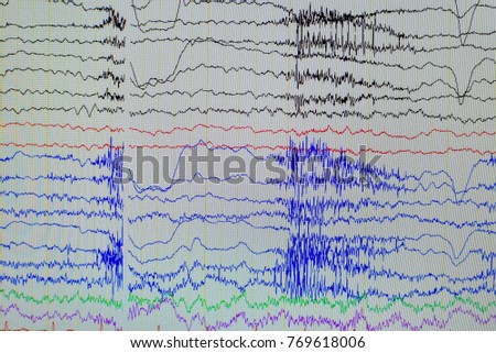 Electroencephalographic waves of patients brain,Samples of brain waves activity, recording EEG waves  
