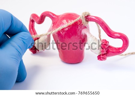 Tubal ligation or surgical procedure tubectomy in operative gynecology concept photo. Doctor binds with rope fallopian tubes model of female genital organs uterus and ovaries. Surgical sterilization Royalty-Free Stock Photo #769655650