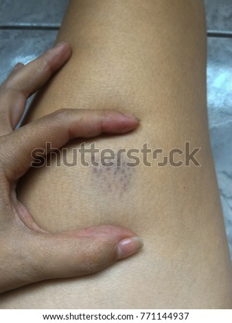 Bruise injury on leg of young woman. Close up image of female person with wounded leg with hematoma.
