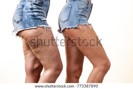 Comparison of female legs thighs with and without cellulite. Skin problem, body care, overweight and dieting concept. Royalty-Free Stock Photo #773387890