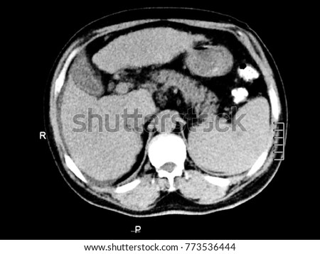 CT of liver