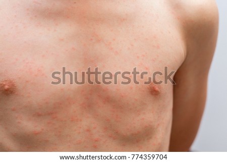 child with dermatitis problem of rash, Allergy rash on his body.
