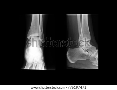 X-ray radiograph of human female heel bones
