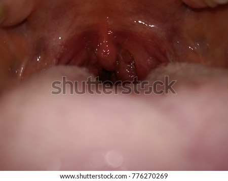 Sore throat, larynx and vocal cords Royalty-Free Stock Photo #776270269
