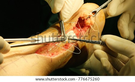 Ruptured Achilles Tendon with surgical correction.
