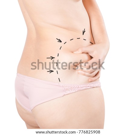 Plastic surgery of the female body. Liposuction of the tummy tuck, waist. Drawing arrows and lines with perforation for preparation for surgery. Fat woman in underwear isolated on white background