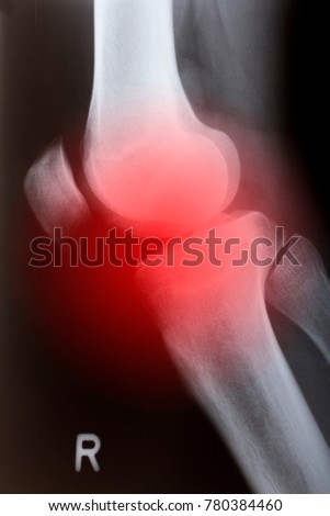 Human knee sidelong in x-ray