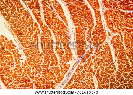 chronic myocarditis diseased tissue under the microscope Royalty-Free Stock Photo #781618378