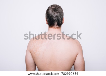 young man student with a broad back and gray hair. dressed in shorts. posing in Studio on a white textured background. spots on the body: a mole and a birthmark. dermatological disease. body parts