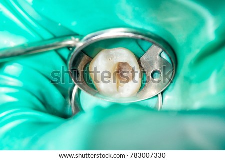 rotten carious tooth close-up with a dental mirror Royalty-Free Stock Photo #783007330