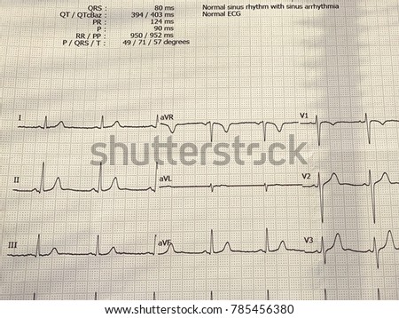 Electrocardiogram result normal on paper form concept for check up health screening