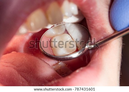 two chewing side teeth of the upper jaw after treatment of caries. Restoration of the chewing surface with a photopolymer filling material using the Rubber Dam system Royalty-Free Stock Photo #787431601