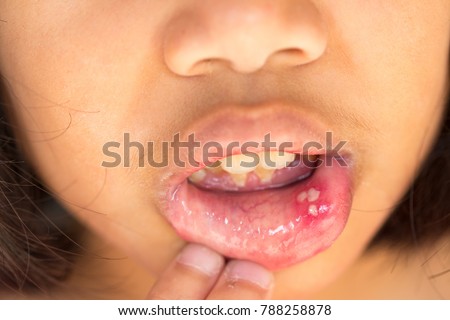 mouth ulcer or canker sore or aphthous stomatitis or  aphthous ulcer Royalty-Free Stock Photo #788258878