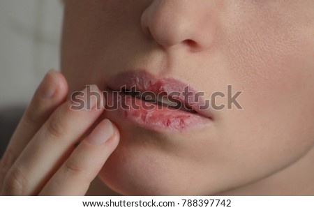 Dermatillomania skin picking. Woman has bad habit to pick her lips. Harmful addiction based on anxiety stress and dry lips. Excoriation disorder. Sick cracked damaged tissue. Royalty-Free Stock Photo #788397742