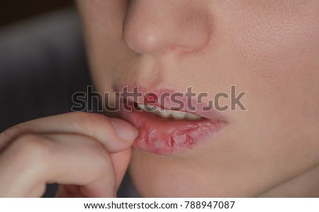 Dermatillomania skin picking. Woman has bad habit to pick her lips. Harmful addiction based on anxiety stress and dry lips. Excoriation disorder. Sick cracked damaged tissue. Royalty-Free Stock Photo #788947087