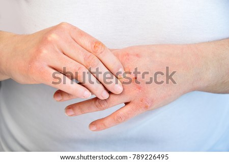 Woman checking the hand with very dry skin and deep cracks Royalty-Free Stock Photo #789226495