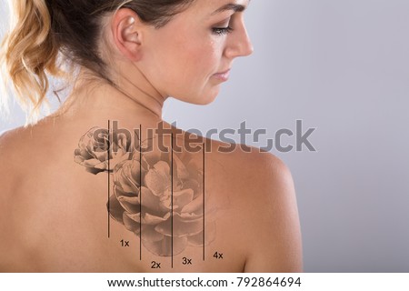 Laser Tattoo Removal On Woman's Shoulder Against Gray Background Royalty-Free Stock Photo #792864694