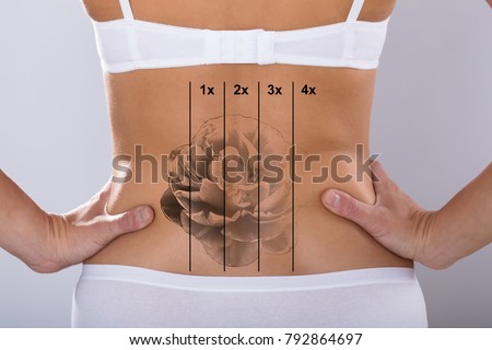 Rear View Of Laser Tattoo Removal On Woman's Hip Royalty-Free Stock Photo #792864697