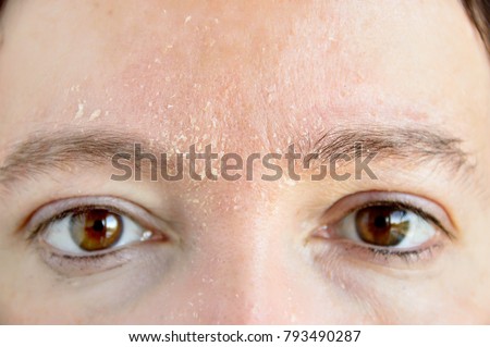 woman with symptom of atopic dermatitis on brow and brows Royalty-Free Stock Photo #793490287