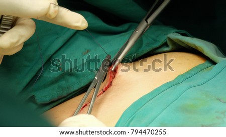 Scissors as a Surgical Instruments during Operation.Straight scissor used to cut suture material where as curve scissor for tissue.