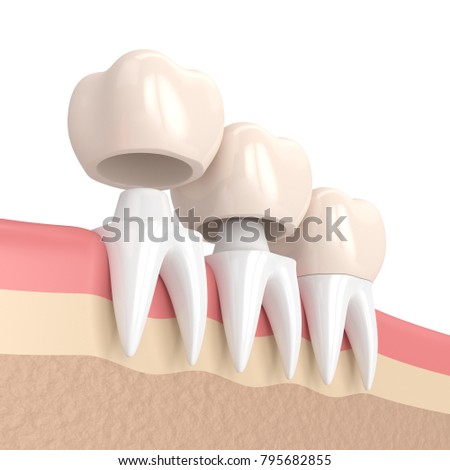 3d render of  replacement crowns cemented onto reshaped teeth in gums