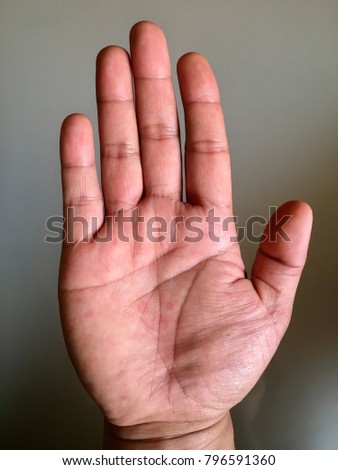 Allergy on hand Royalty-Free Stock Photo #796591360