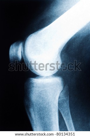 Authentic x-ray of male left knee