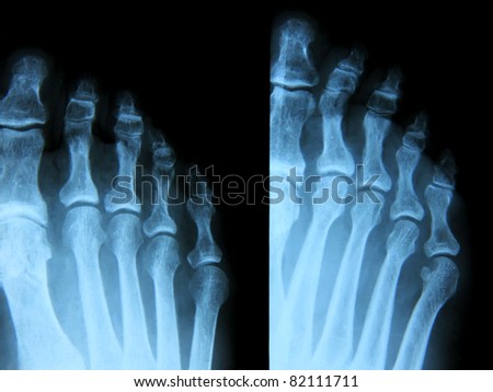 X-ray of human right foot.