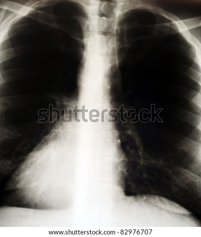 x-ray image of the thorax of  man