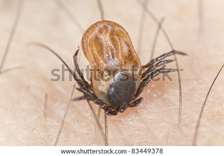 Tick feeding on human, extreme close up with high magnification, focus on tick head Royalty-Free Stock Photo #83449378
