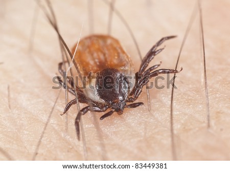 Tick feeding on human, extreme close up with high magnification, focus on tick head Royalty-Free Stock Photo #83449381