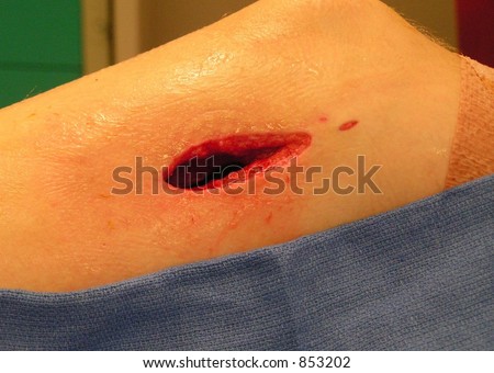 SURGICAL WOUND ON LEFT FEMUR OF TEENAGE BOY RESULTING FROM OSTEOMYELITIS - some noise Royalty-Free Stock Photo #853202