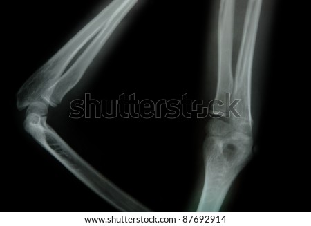 x-ray of a young people arm