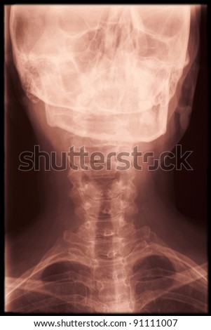 X-ray of a human neck illuminated by a light box