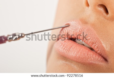 Lip Enhancement Treatment. Closeup of a hypodermic needle being using to inject the upper lip in an enhancement treatment.