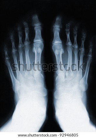Foot fingers exposed on x-ray