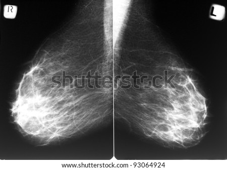 Mammogram films of both breasts of a female patient