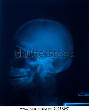  X-ray film of  Skull lateral