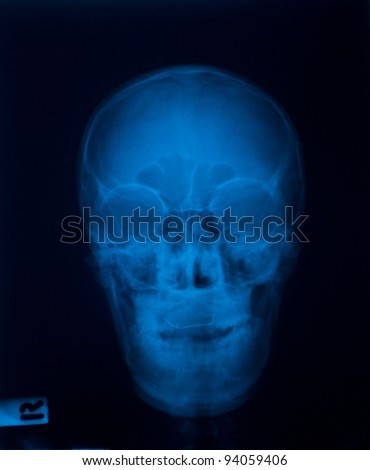  X-ray film of  Skull